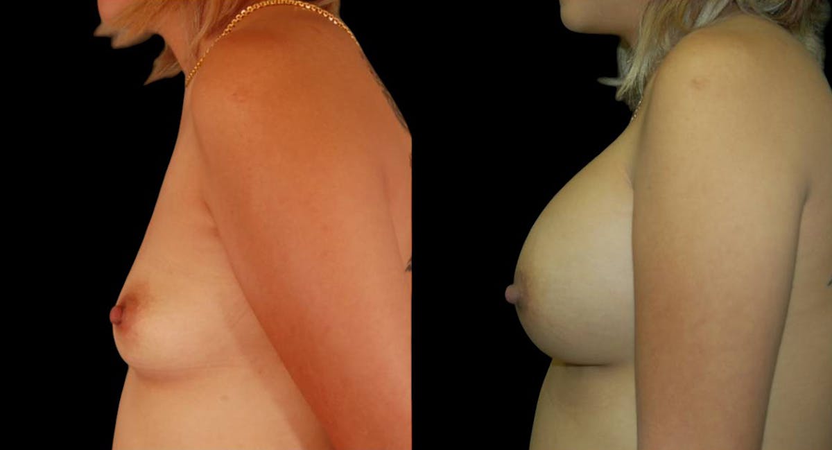 Breast Augmentation Before & After Gallery - Patient 204402 - Image 5