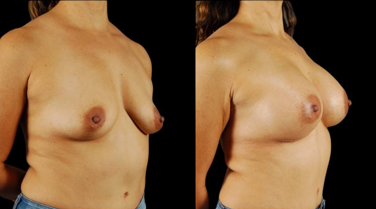 Breast Augmentation Before & After Gallery - Patient 425468 - Image 2