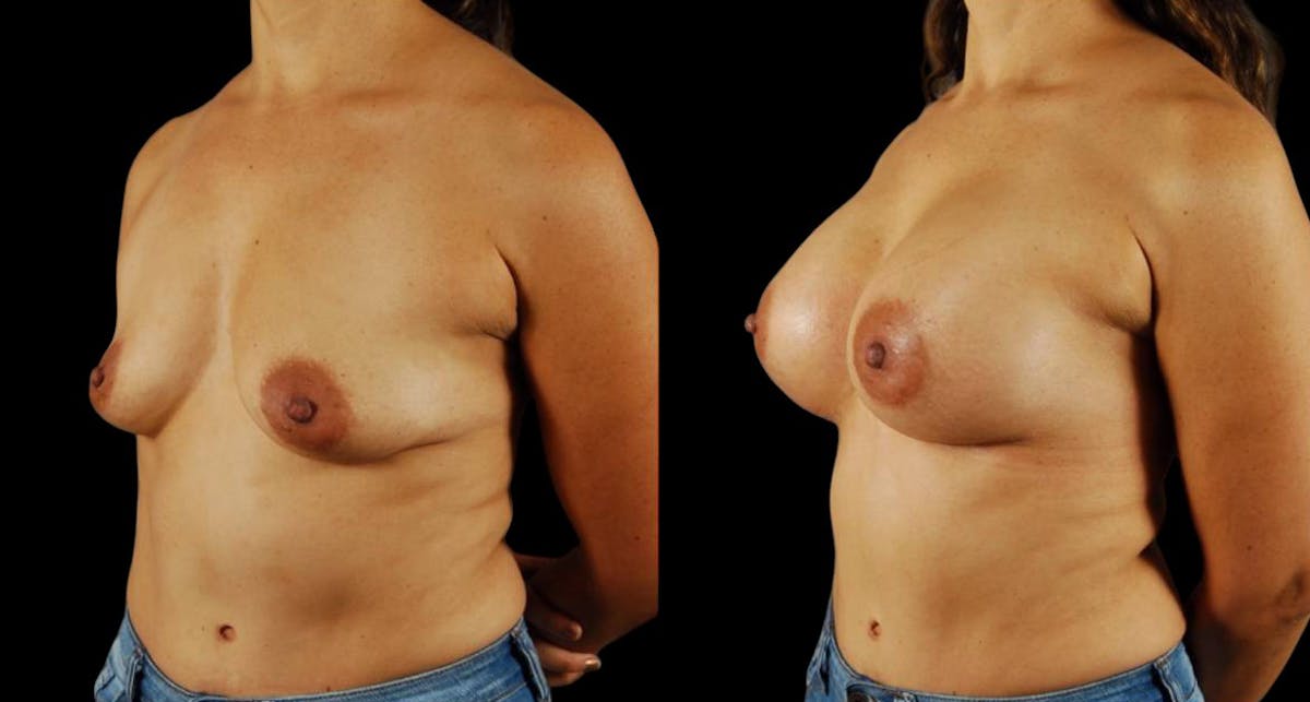 Breast Augmentation Before & After Gallery - Patient 425468 - Image 4