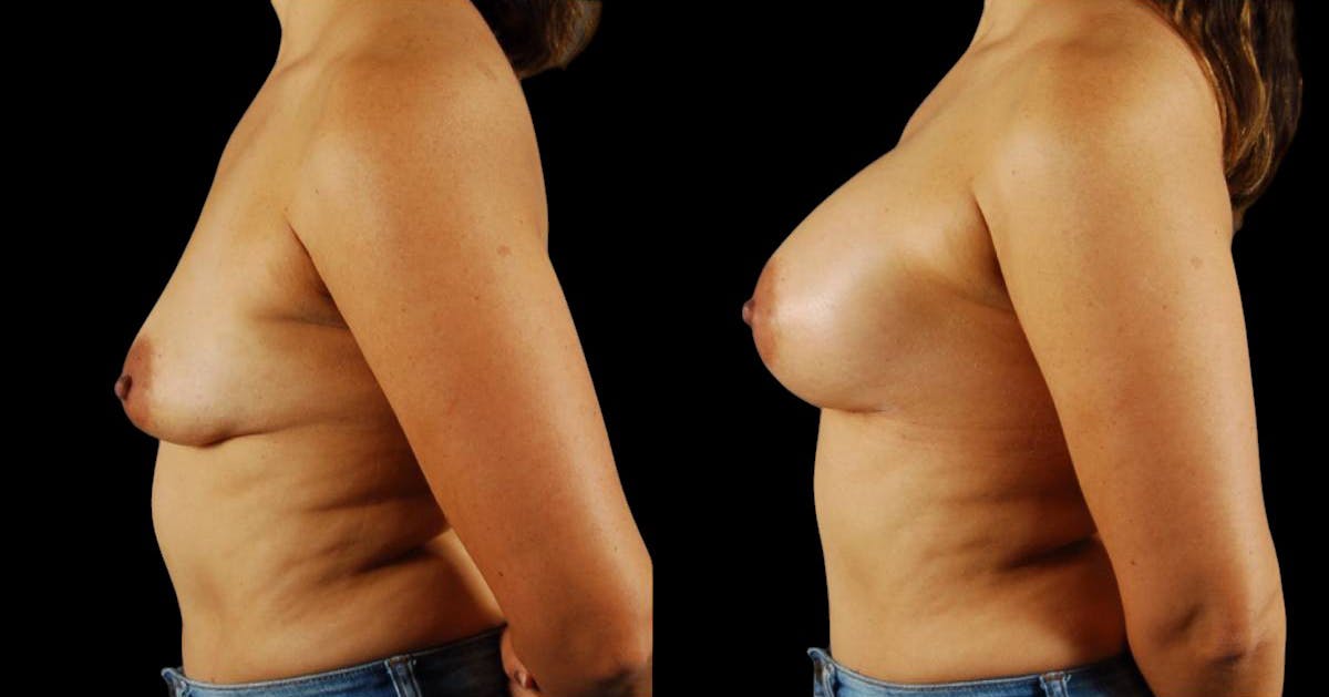 Breast Augmentation Before & After Gallery - Patient 425468 - Image 5