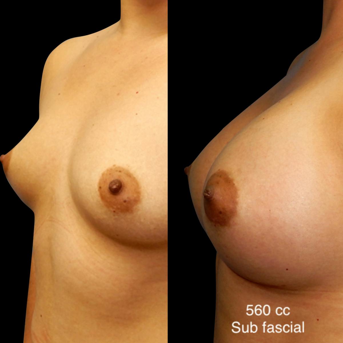 Breast Augmentation Before & After Gallery - Patient 633552 - Image 2