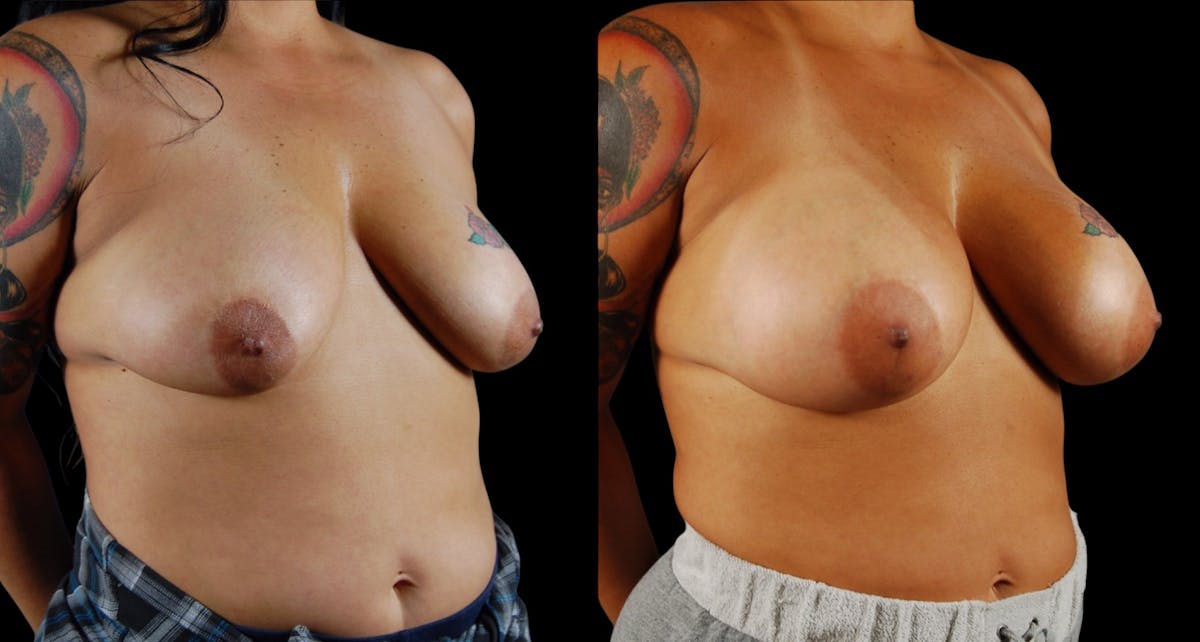 Breast Augmentation Before & After Gallery - Patient 213267 - Image 2
