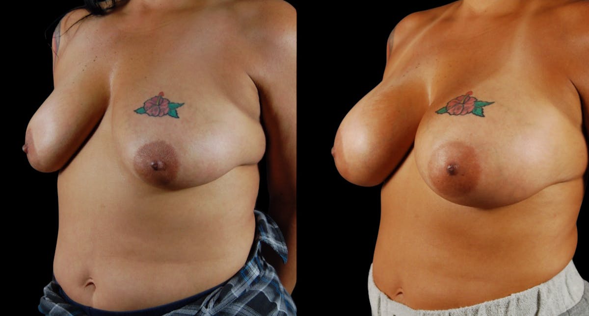 Breast Augmentation Before & After Gallery - Patient 213267 - Image 3