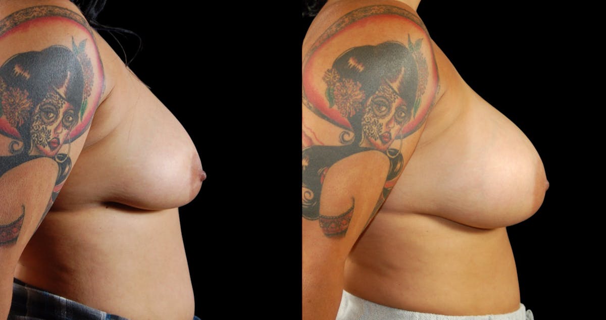 Breast Augmentation Before & After Gallery - Patient 213267 - Image 4