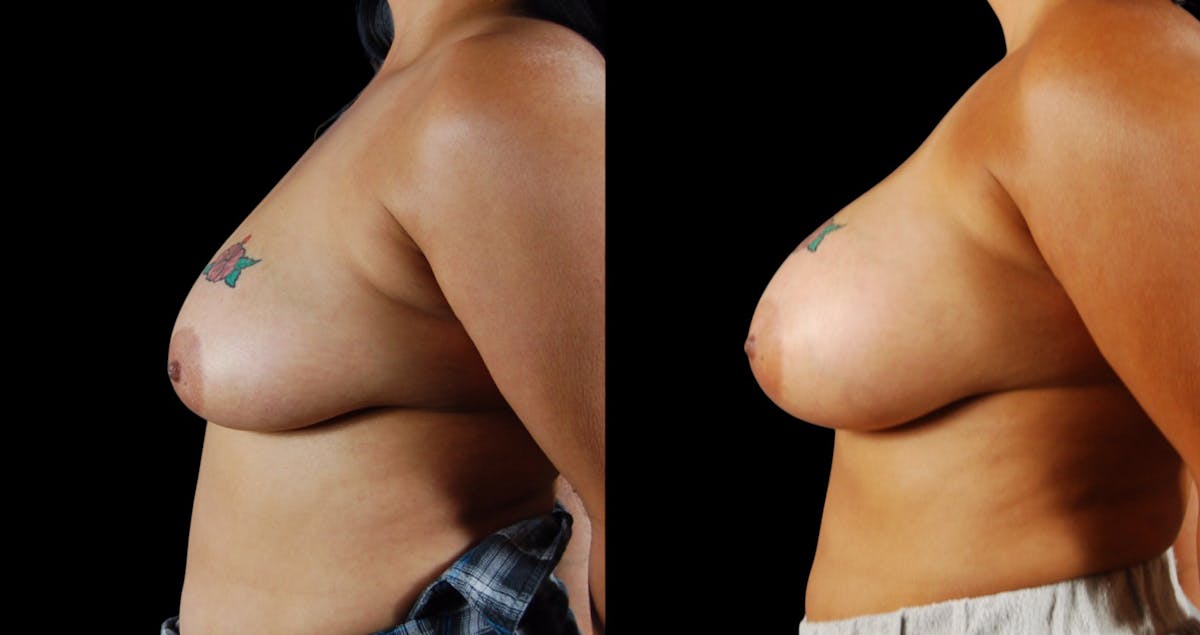 Breast Augmentation Before & After Gallery - Patient 213267 - Image 5