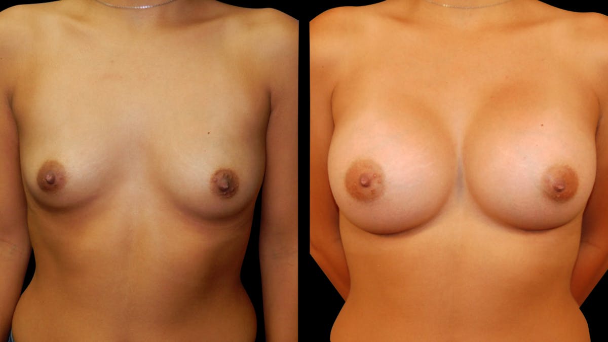 Breast Augmentation Before & After Gallery - Patient 460877 - Image 1
