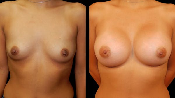 Breast Augmentation Before & After Gallery - Patient 460877 - Image 1
