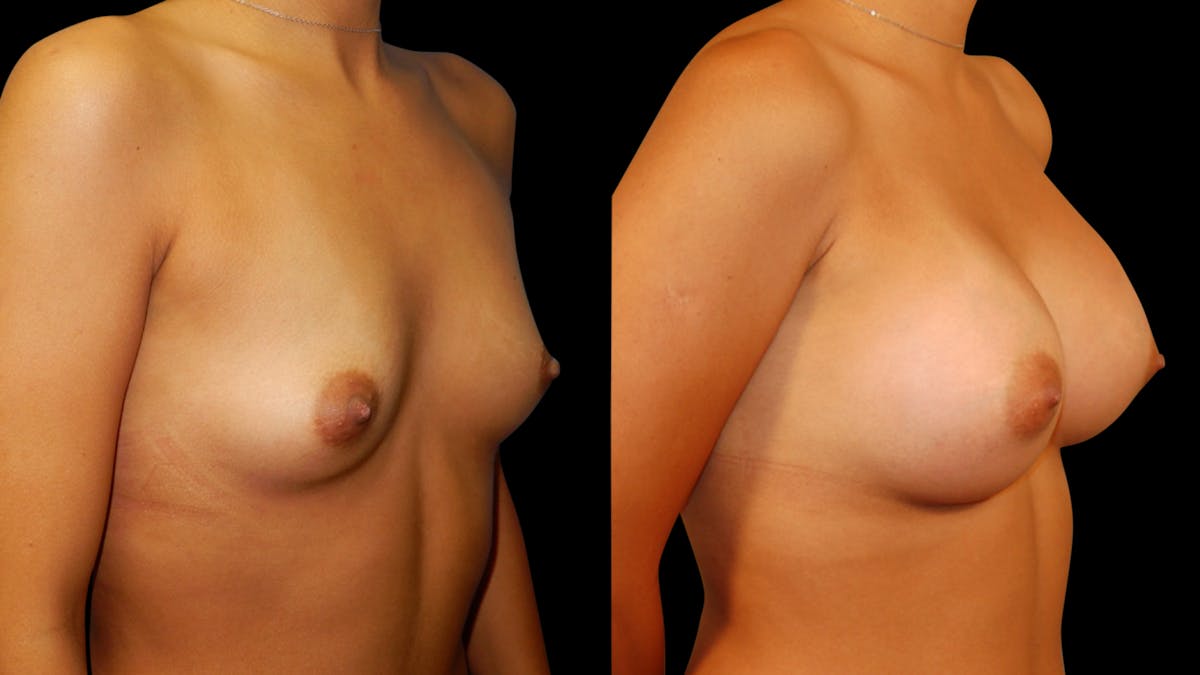 Breast Augmentation Before & After Gallery - Patient 460877 - Image 2