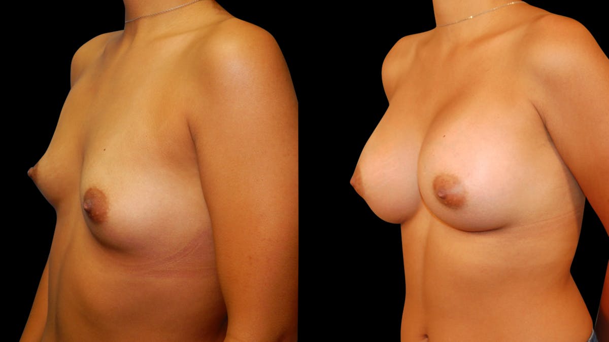 Breast Augmentation Before & After Gallery - Patient 460877 - Image 3