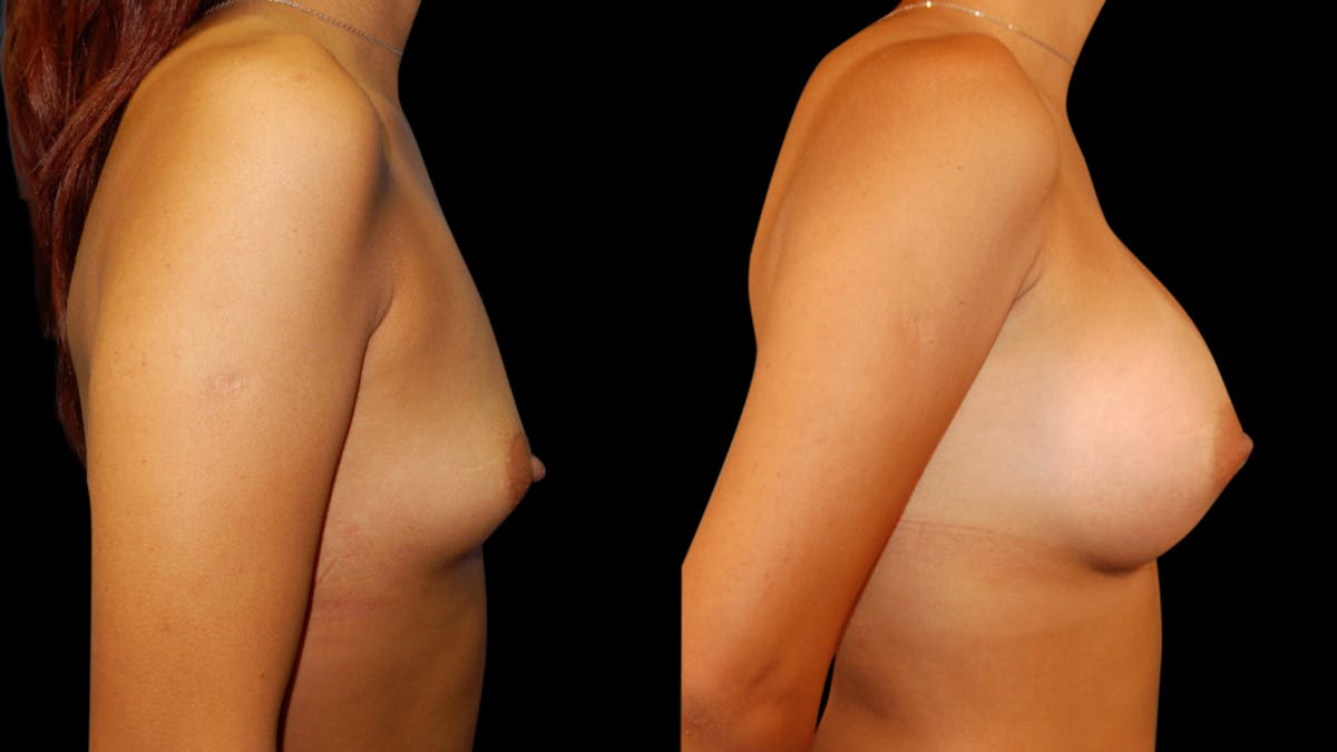 Breast Augmentation Before & After Gallery - Patient 460877 - Image 4