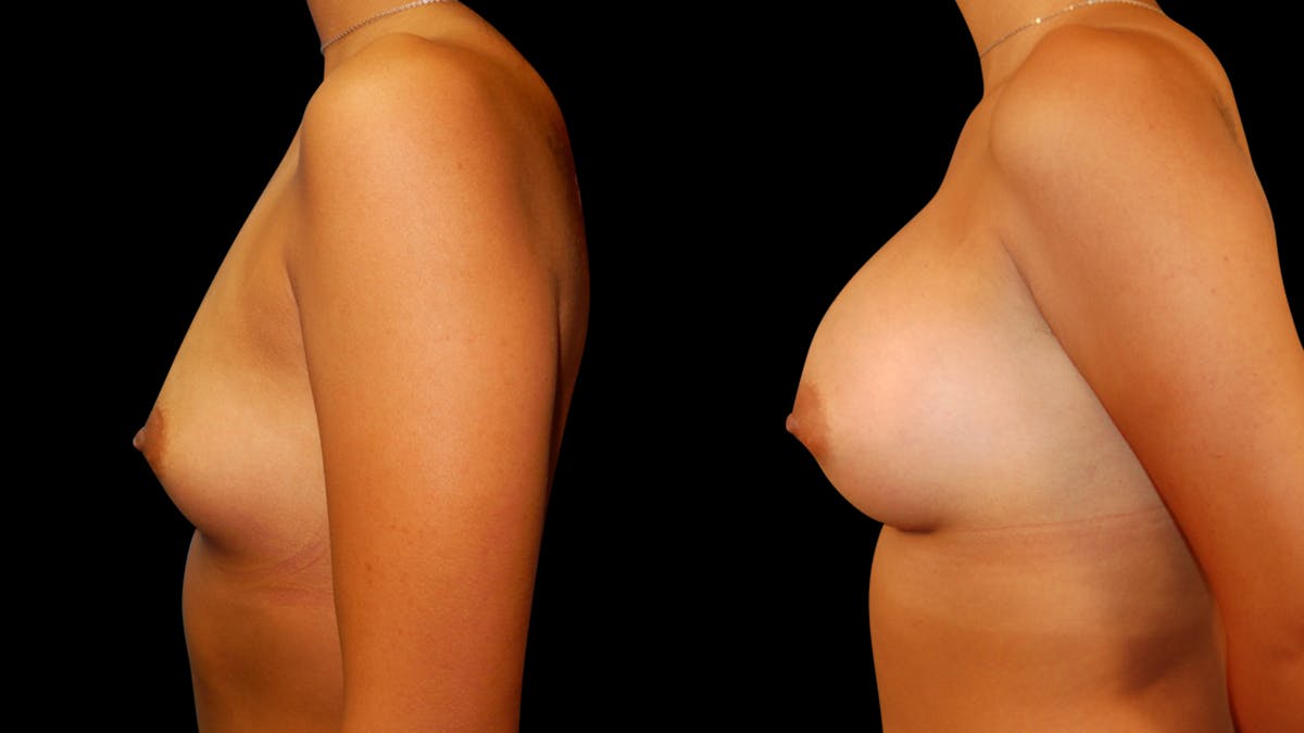 Breast Augmentation Before & After Gallery - Patient 460877 - Image 5