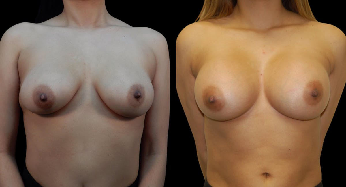 Breast Augmentation Before & After Gallery - Patient 313926 - Image 1