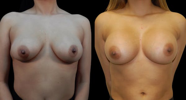 Breast Augmentation Before & After Gallery - Patient 313926 - Image 1