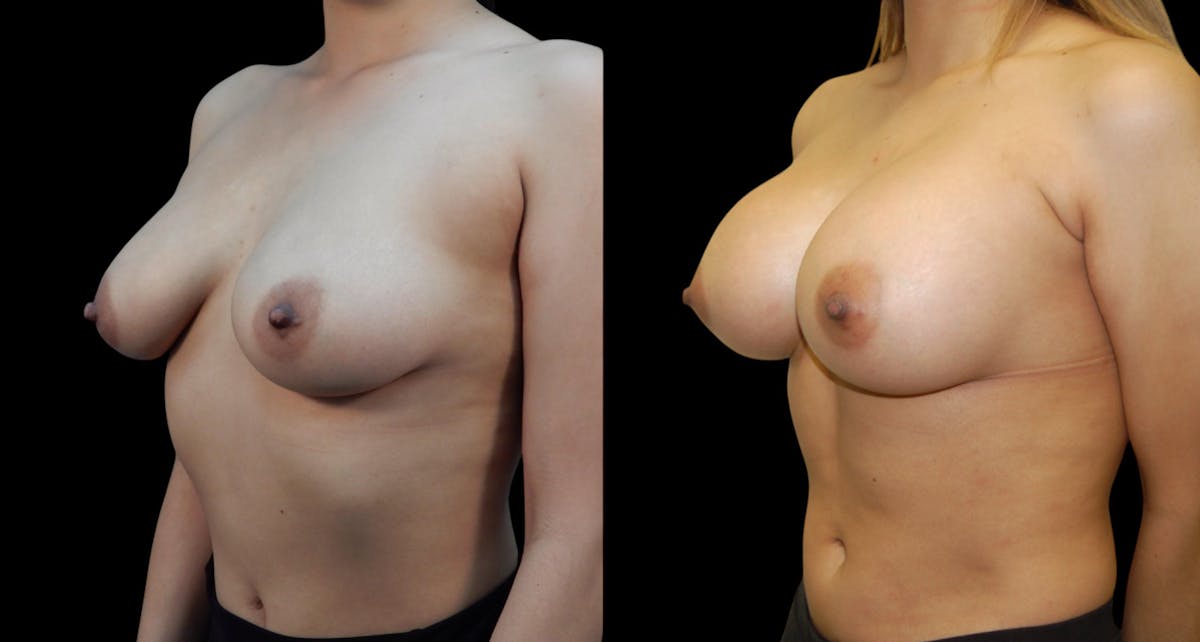 Breast Augmentation Before & After Gallery - Patient 313926 - Image 2