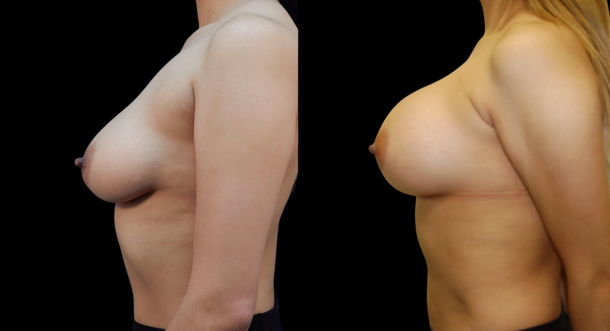 Breast Augmentation Before & After Gallery - Patient 313926 - Image 3