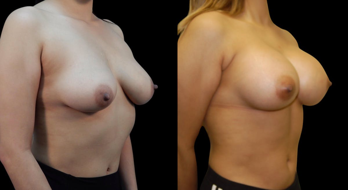 Breast Augmentation Before & After Gallery - Patient 313926 - Image 4