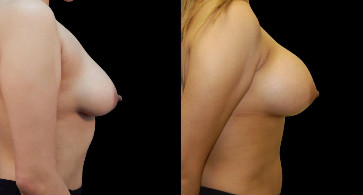Breast Augmentation Before & After Gallery - Patient 313926 - Image 5