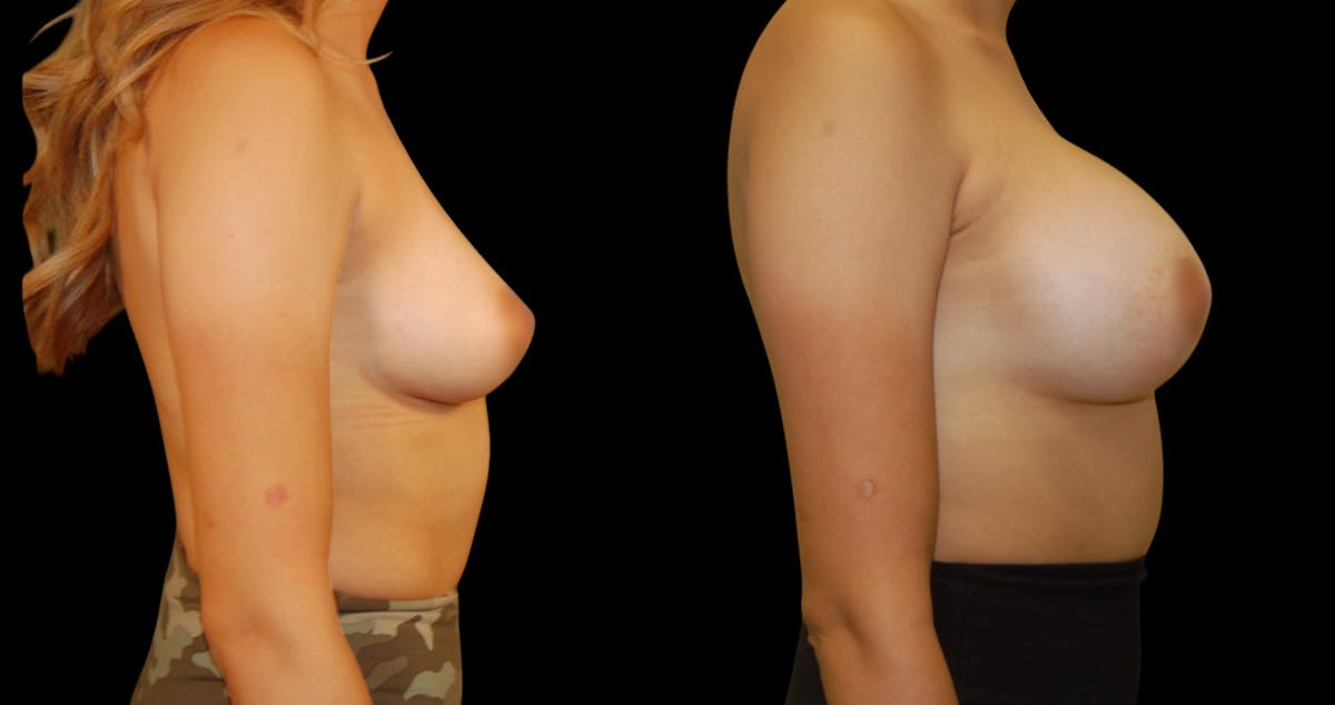 Breast Augmentation Before & After Gallery - Patient 319214 - Image 3