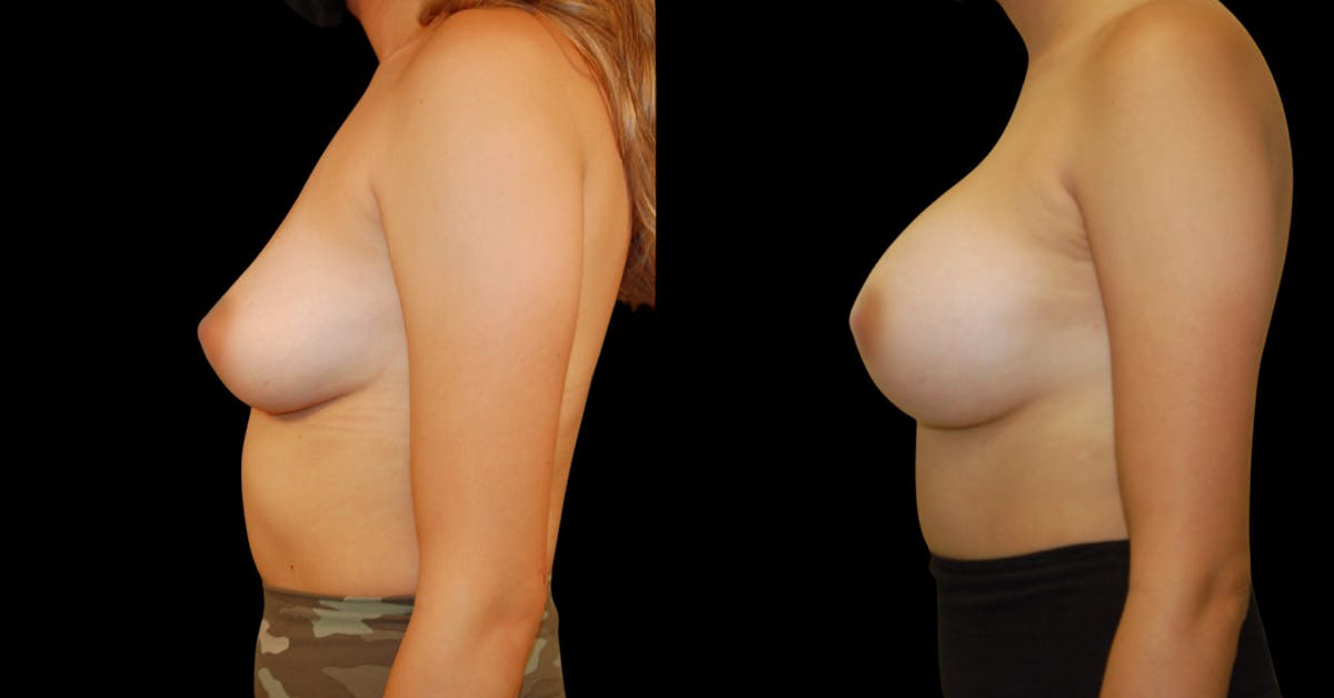 Breast Augmentation Before & After Gallery - Patient 319214 - Image 5