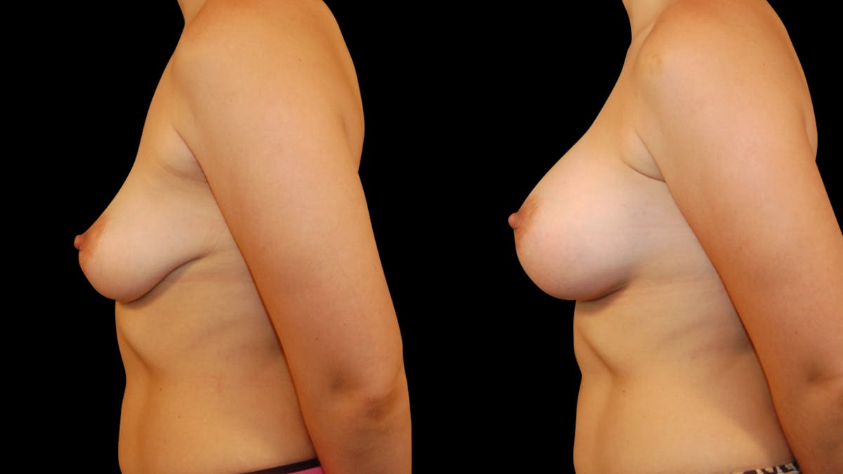 Breast Augmentation Before & After Gallery - Patient 387929 - Image 3