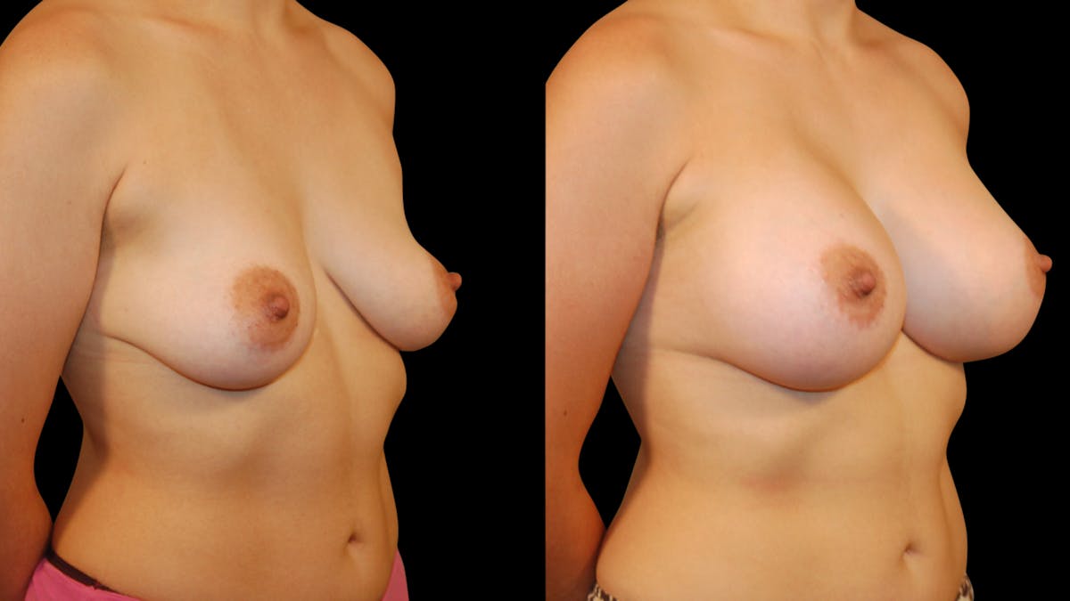 Breast Augmentation Before & After Gallery - Patient 387929 - Image 4