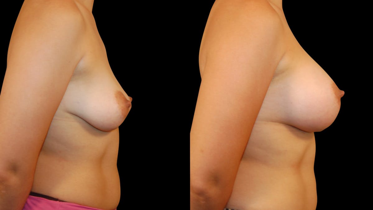 Breast Augmentation Before & After Gallery - Patient 387929 - Image 5