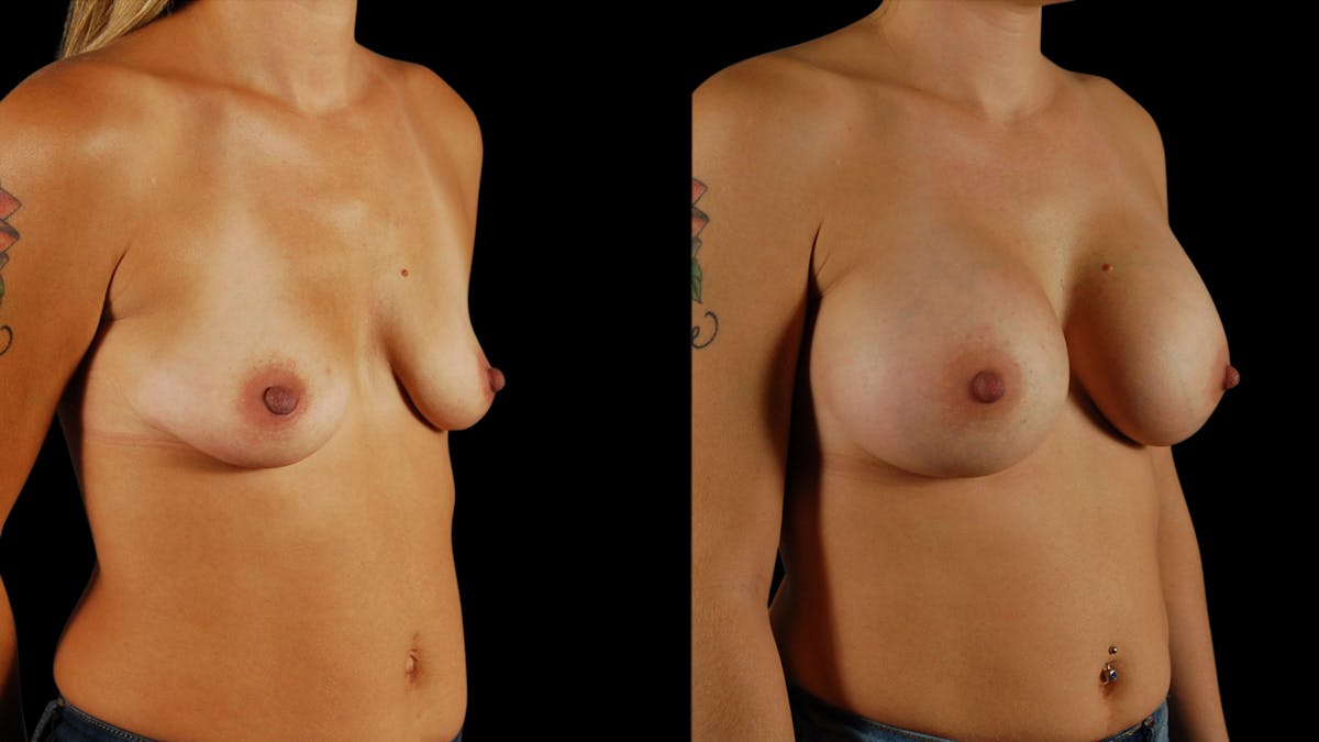 Breast Augmentation Before & After Gallery - Patient 396264 - Image 2
