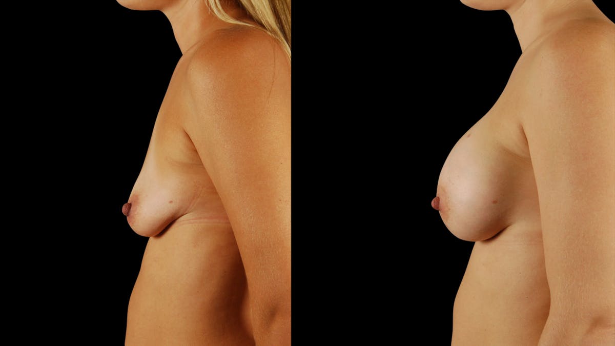 Breast Augmentation Before & After Gallery - Patient 396264 - Image 3