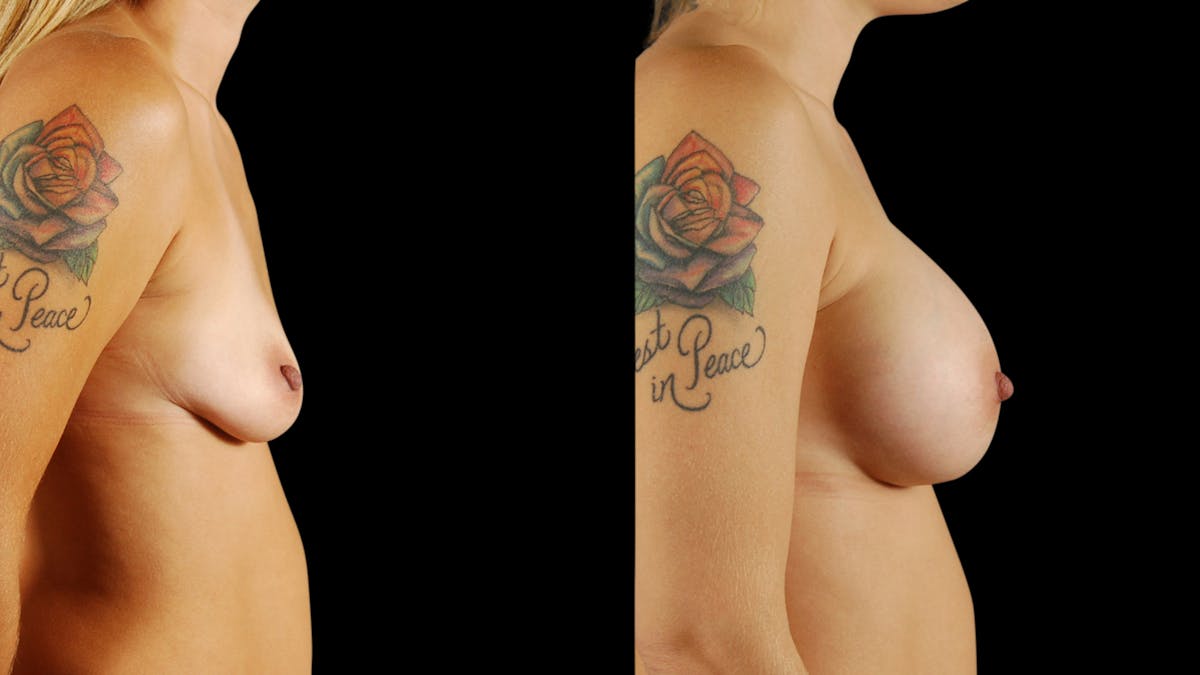 Breast Augmentation Before & After Gallery - Patient 396264 - Image 5