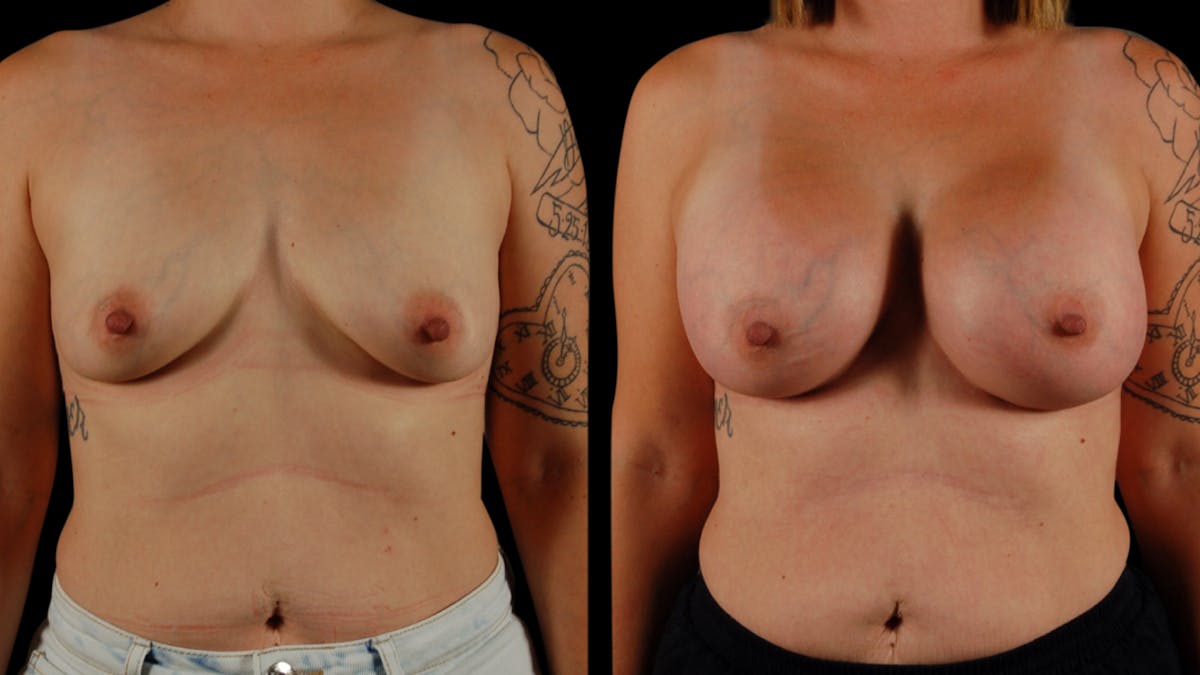 Breast Augmentation Before & After Gallery - Patient 356843 - Image 2