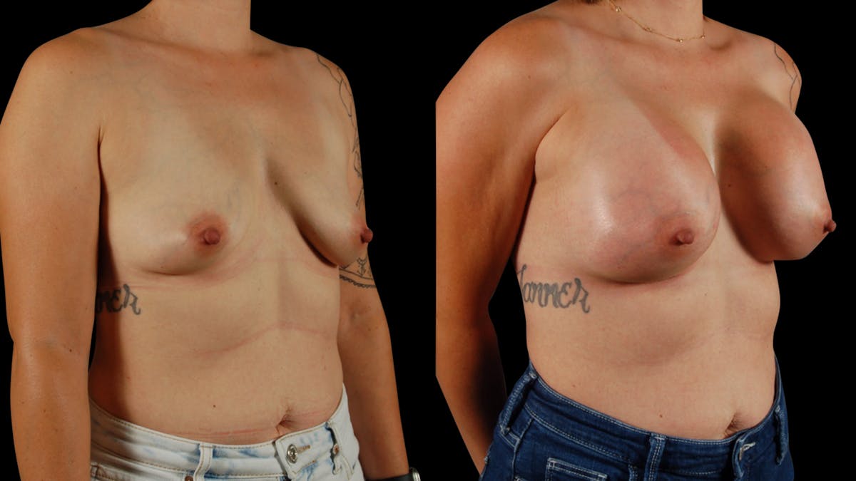 Breast Augmentation Before & After Gallery - Patient 356843 - Image 3