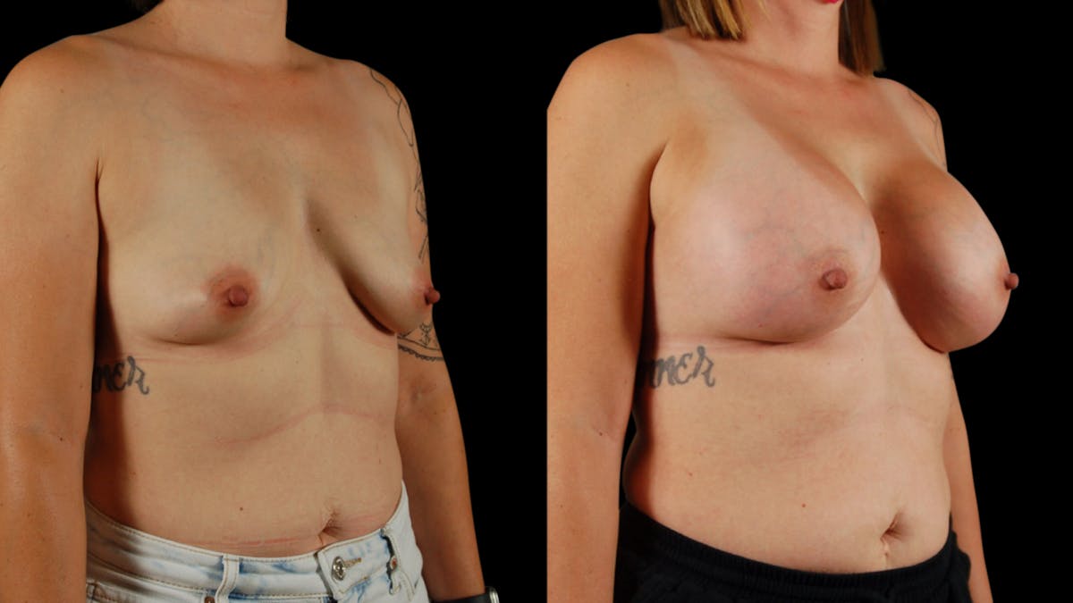 Breast Augmentation Before & After Gallery - Patient 356843 - Image 4