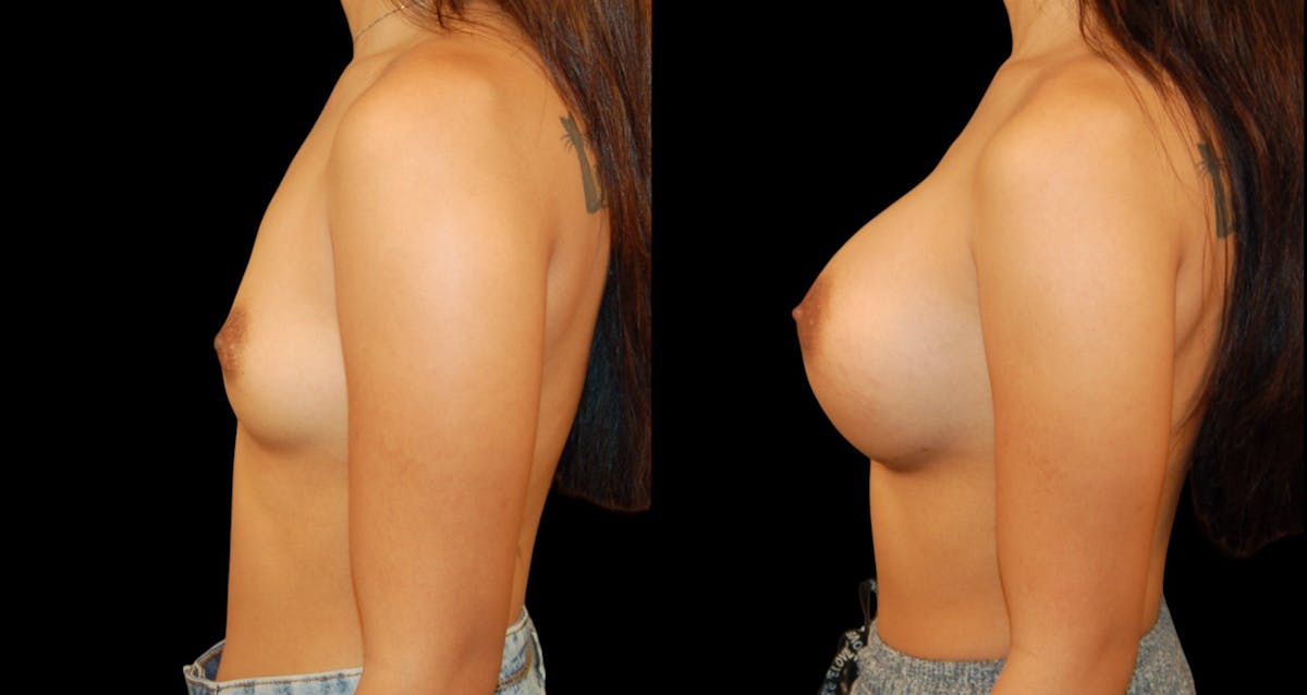 Breast Augmentation Before & After Gallery - Patient 840941 - Image 3