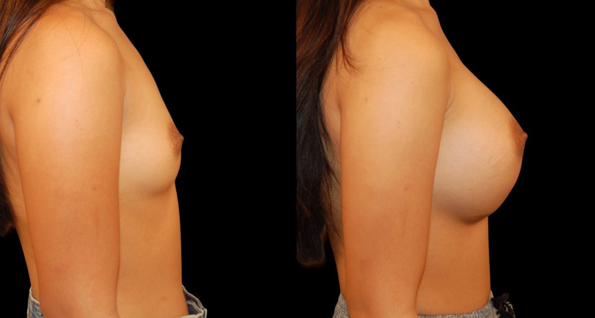 Breast Augmentation Before & After Gallery - Patient 840941 - Image 5