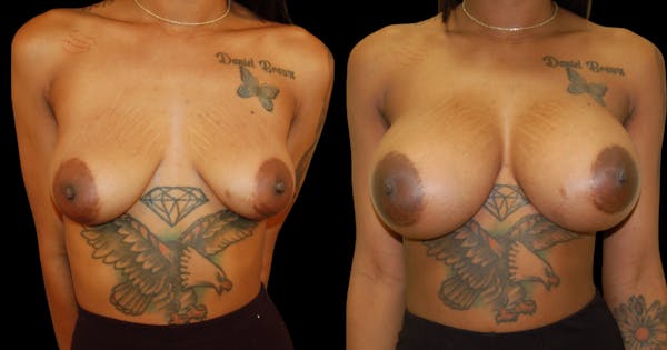 Breast Augmentation Before & After Gallery - Patient 131567 - Image 1