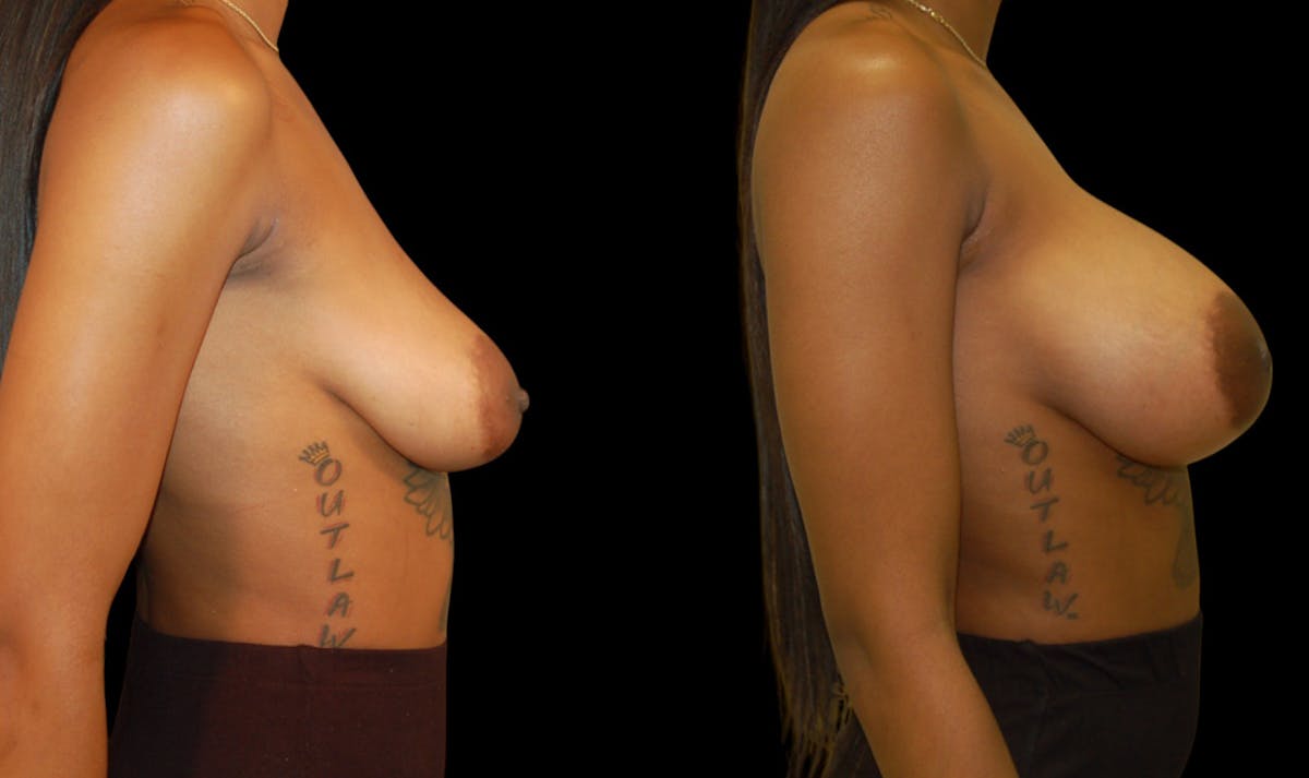 Breast Augmentation Before & After Gallery - Patient 131567 - Image 3