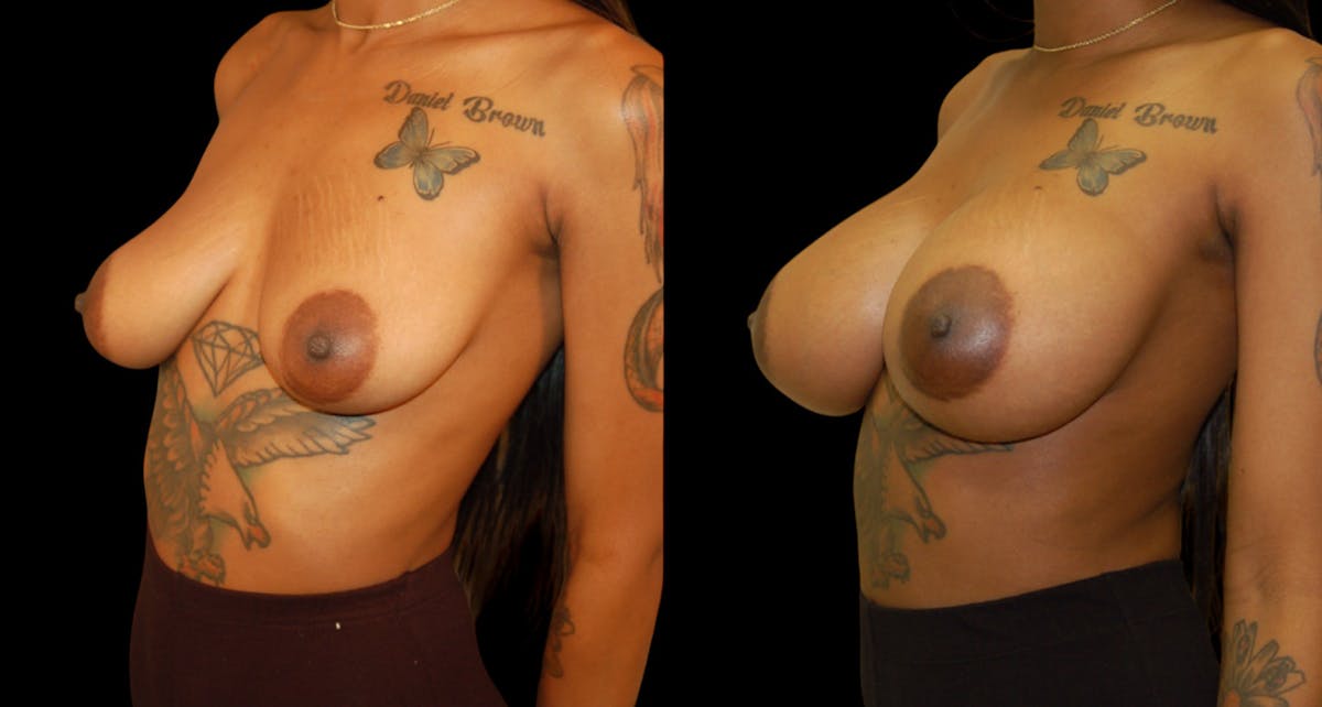 Breast Augmentation Before & After Gallery - Patient 131567 - Image 4