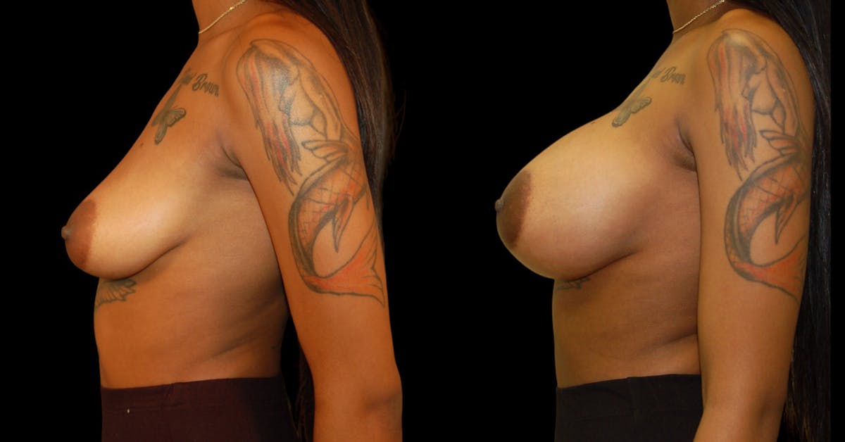 Breast Augmentation Before & After Gallery - Patient 131567 - Image 5