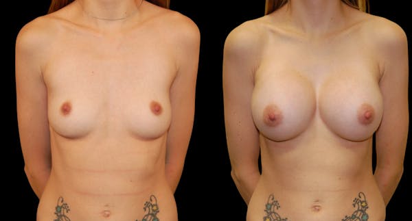 Breast Augmentation Before & After Gallery - Patient 195260 - Image 1