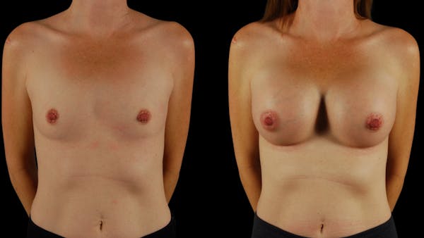 Breast Augmentation Before & After Gallery - Patient 294114 - Image 1