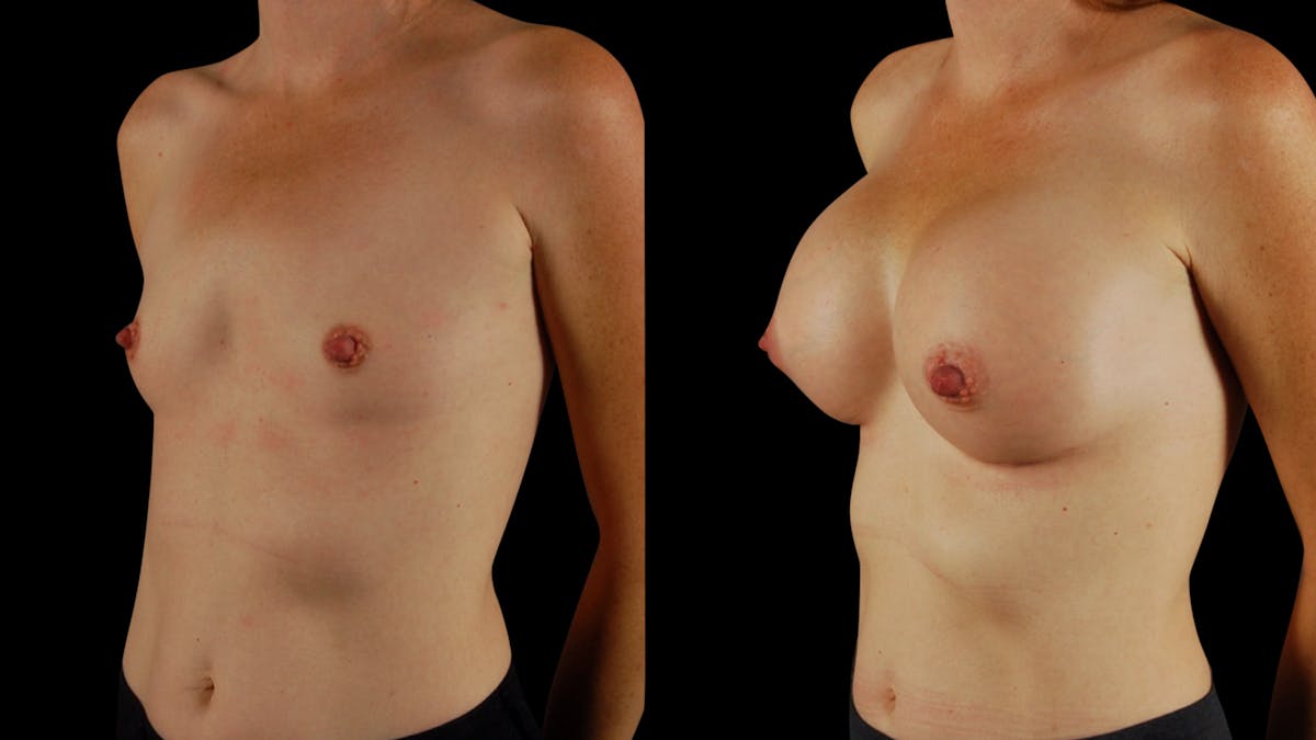 Breast Augmentation Before & After Gallery - Patient 294114 - Image 2