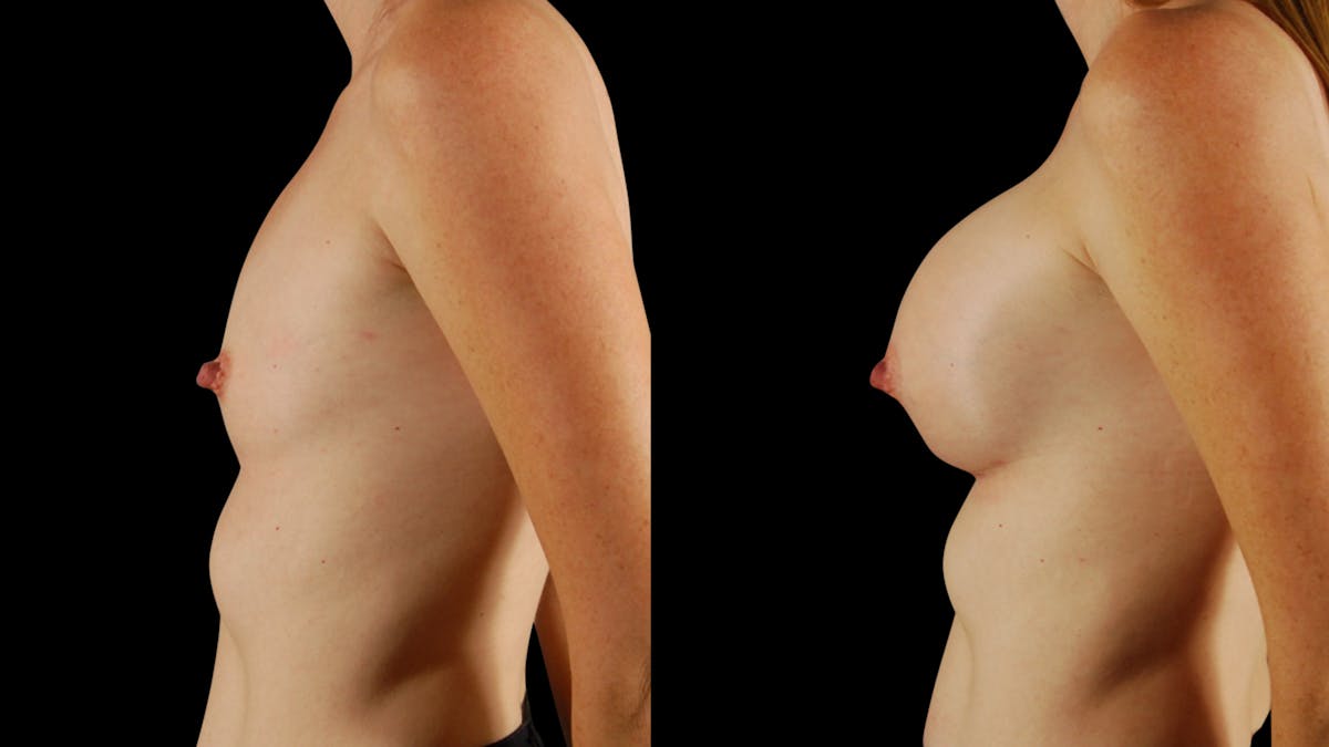 Breast Augmentation Before & After Gallery - Patient 294114 - Image 3