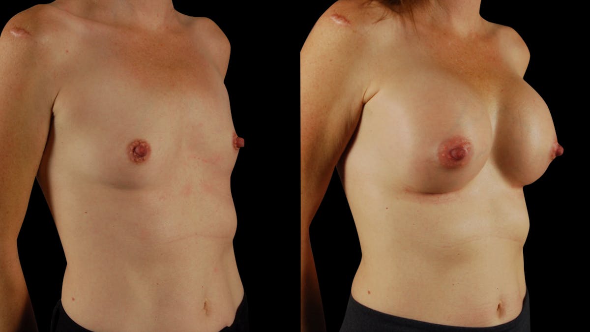 Breast Augmentation Before & After Gallery - Patient 294114 - Image 4