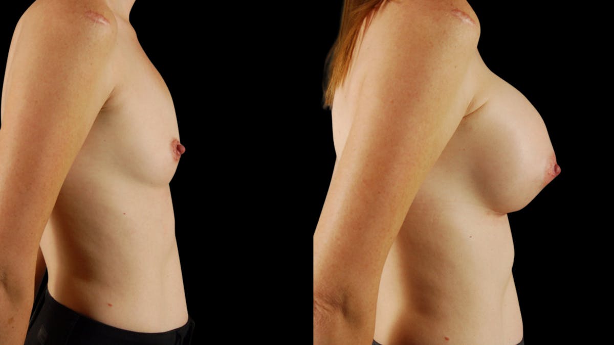 Breast Augmentation Before & After Gallery - Patient 294114 - Image 5