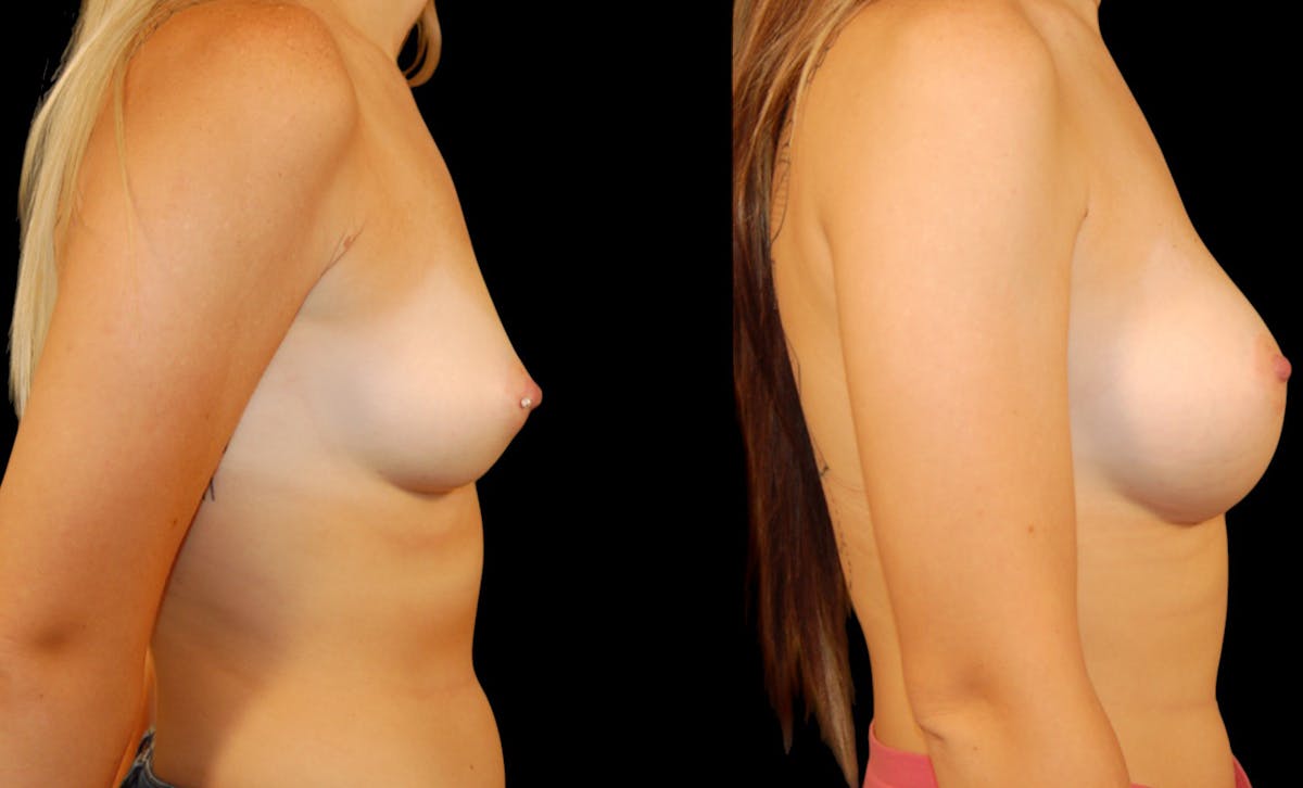 Breast Augmentation Before & After Gallery - Patient 353644 - Image 5