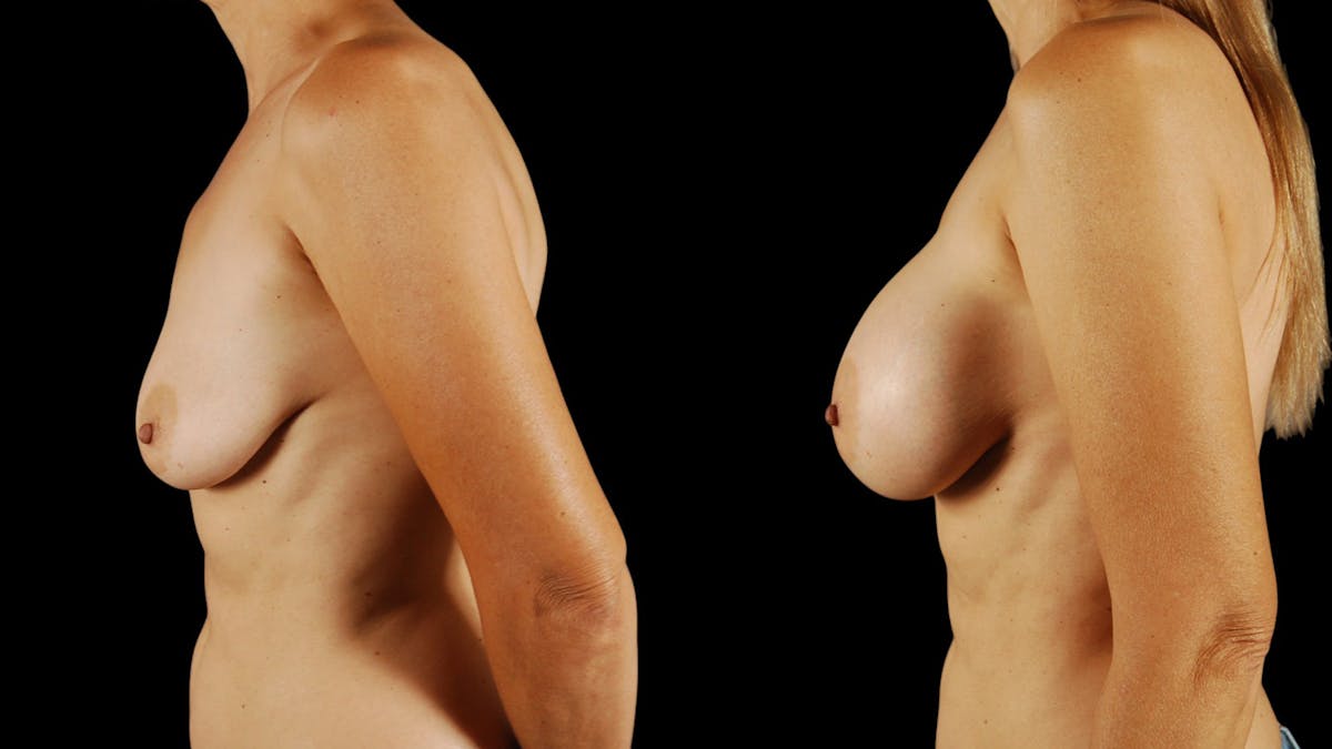 Breast Augmentation Before & After Gallery - Patient 269673 - Image 3