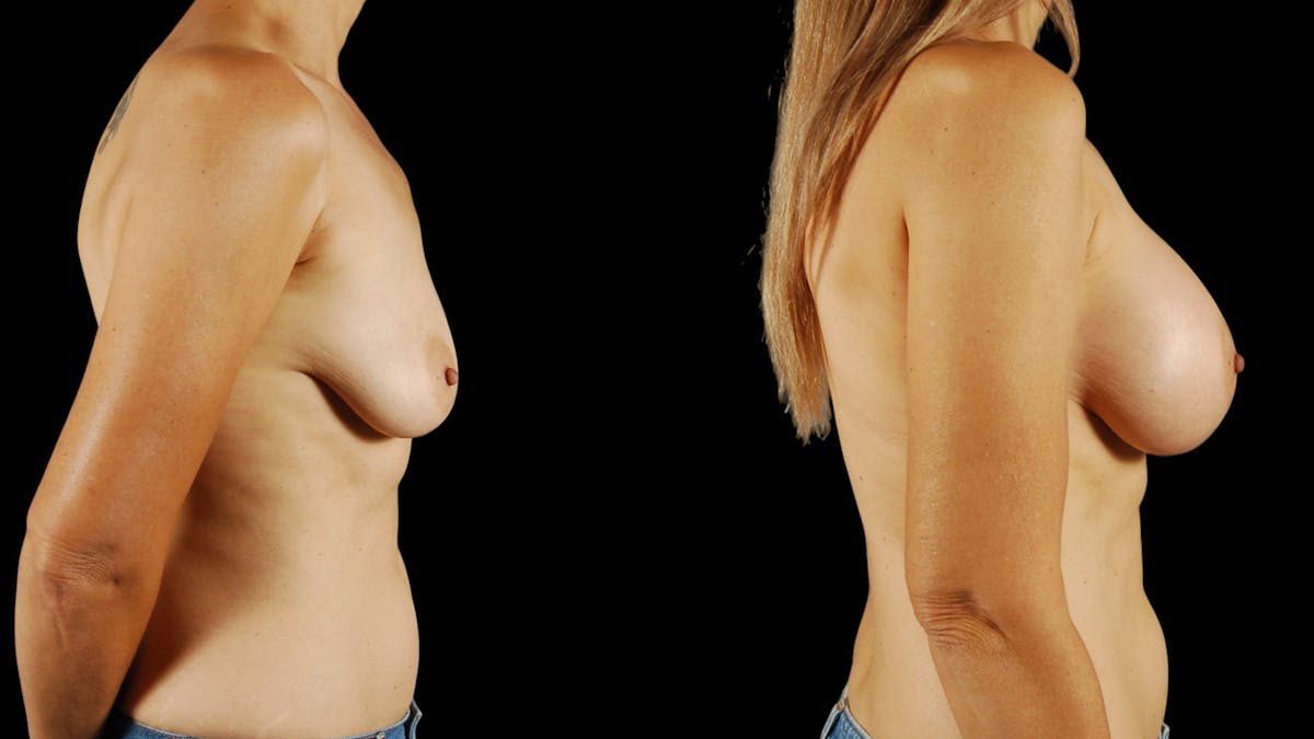 Breast Augmentation Before & After Gallery - Patient 269673 - Image 4