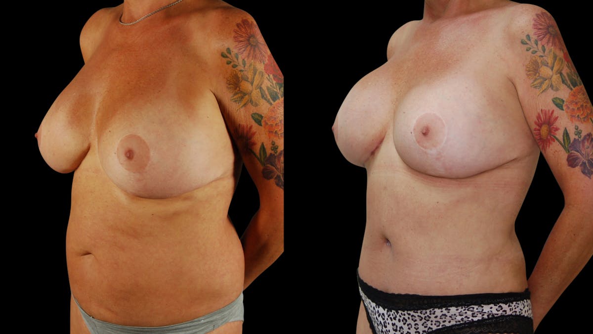 Breast Augmentation Before & After Gallery - Patient 276109 - Image 2