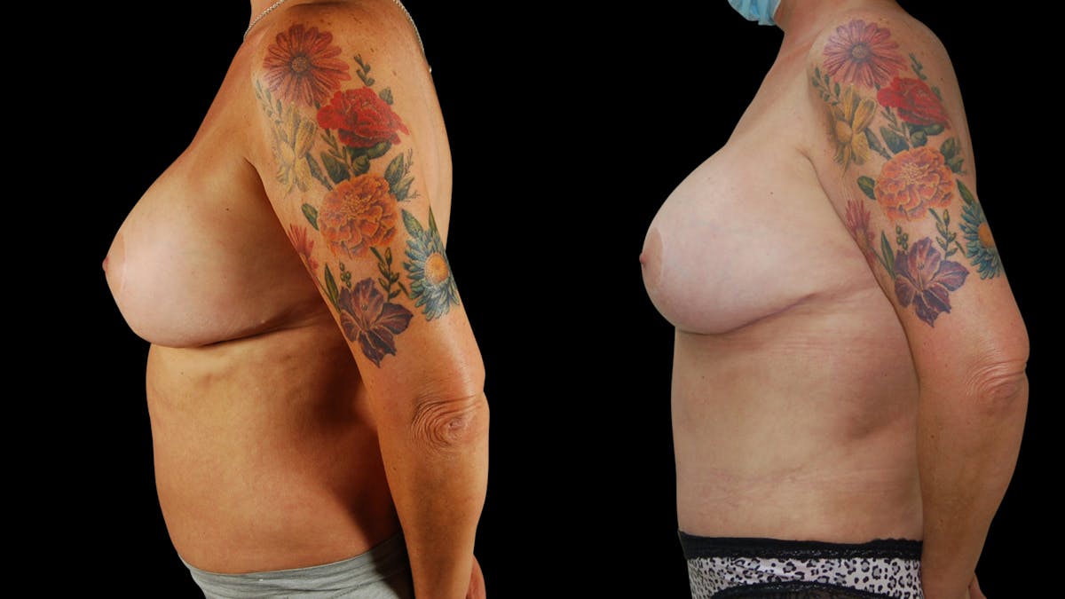 Breast Augmentation Before & After Gallery - Patient 276109 - Image 3