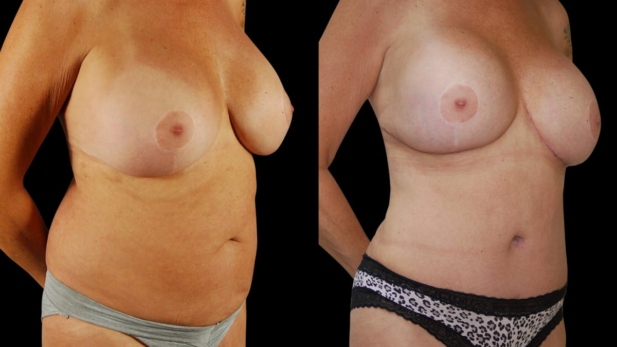 Breast Augmentation Before & After Gallery - Patient 276109 - Image 4